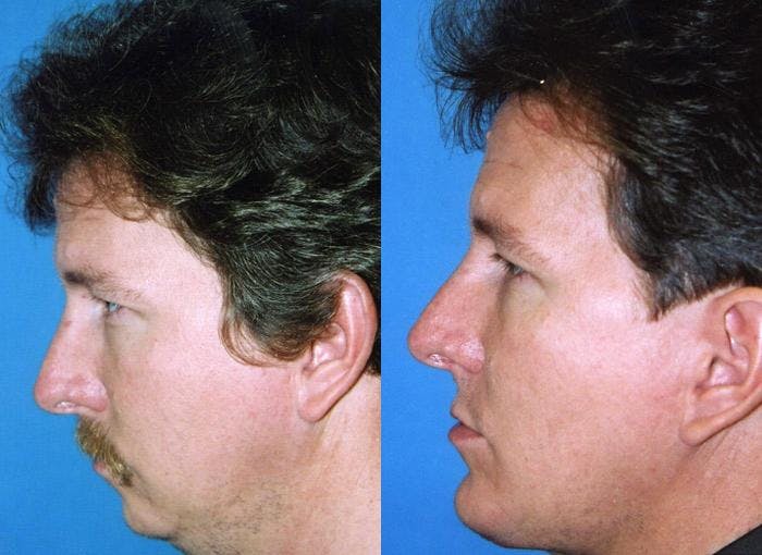 Male Neck Lift Before & After Gallery - Patient 122406300 - Image 1