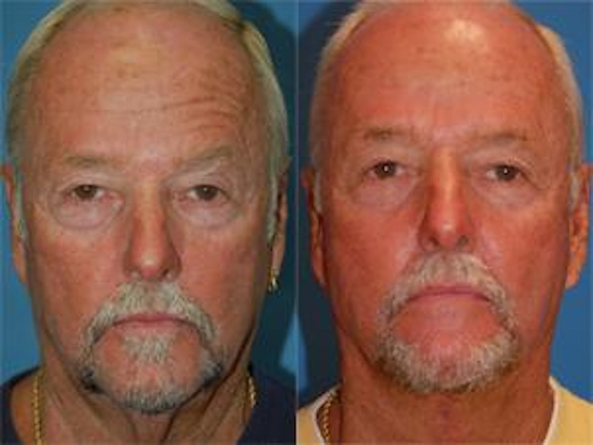 Male Neck Lift Before & After Gallery - Patient 122406302 - Image 1
