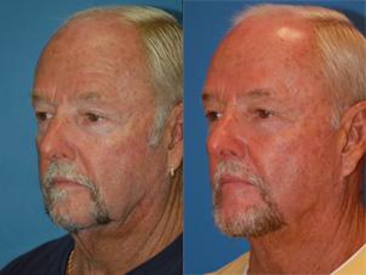 Male Neck Lift Before & After Gallery - Patient 122406302 - Image 2