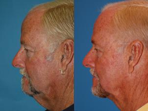 Male Neck Lift Before & After Gallery - Patient 122406302 - Image 3
