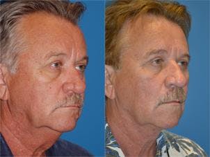 Male Neck Lift Before & After Gallery - Patient 122406304 - Image 1