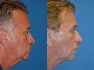 Male Neck Lift Before & After Gallery - Patient 122406304 - Image 2