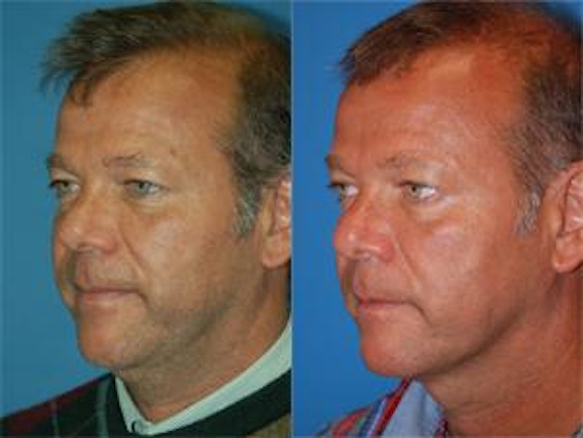 Male Neck Lift Before & After Gallery - Patient 122406309 - Image 1