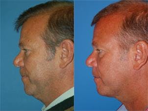 Male Neck Lift Before & After Gallery - Patient 122406309 - Image 2