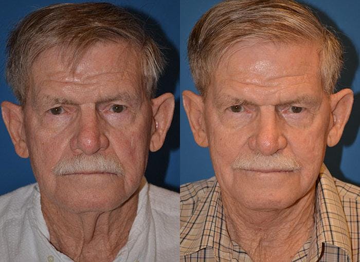 Male Neck Lift Before & After Gallery - Patient 122406310 - Image 1