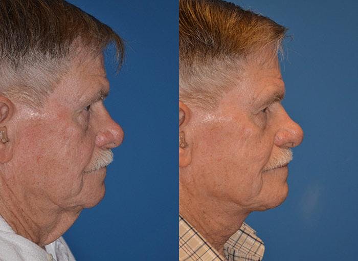 Male Neck Lift Before & After Gallery - Patient 122406310 - Image 2
