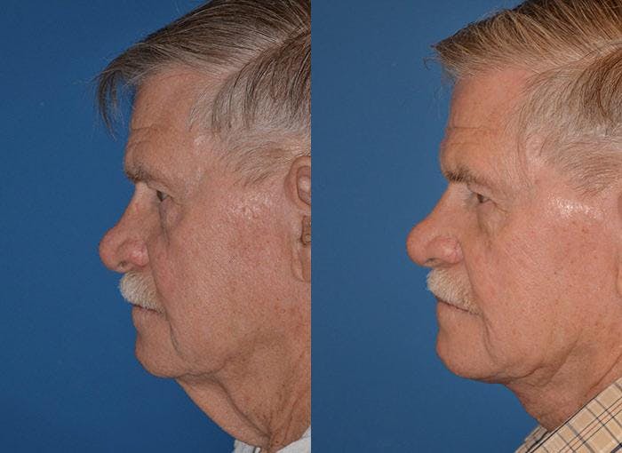 Male Neck Lift Before & After Gallery - Patient 122406310 - Image 3