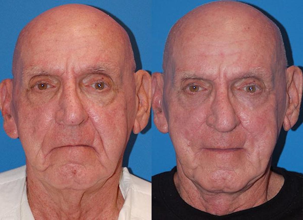 Male Neck Lift Before & After Gallery - Patient 122406311 - Image 1