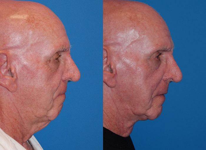 Male Neck Lift Before & After Gallery - Patient 122406311 - Image 2