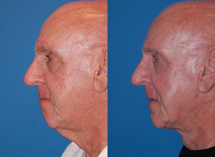 Male Neck Lift Before & After Gallery - Patient 122406311 - Image 3