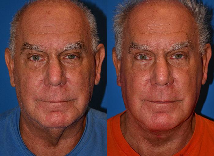 Male Neck Lift Before & After Gallery - Patient 122406313 - Image 1