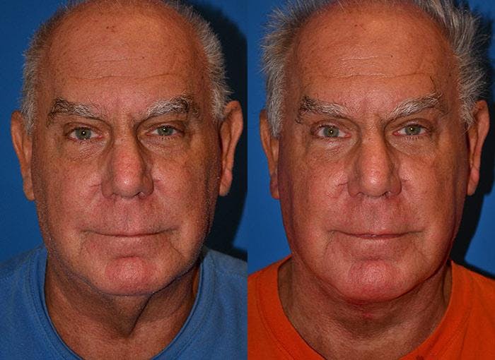 Male Neck Lift Before & After Gallery - Patient 122406313 - Image 1