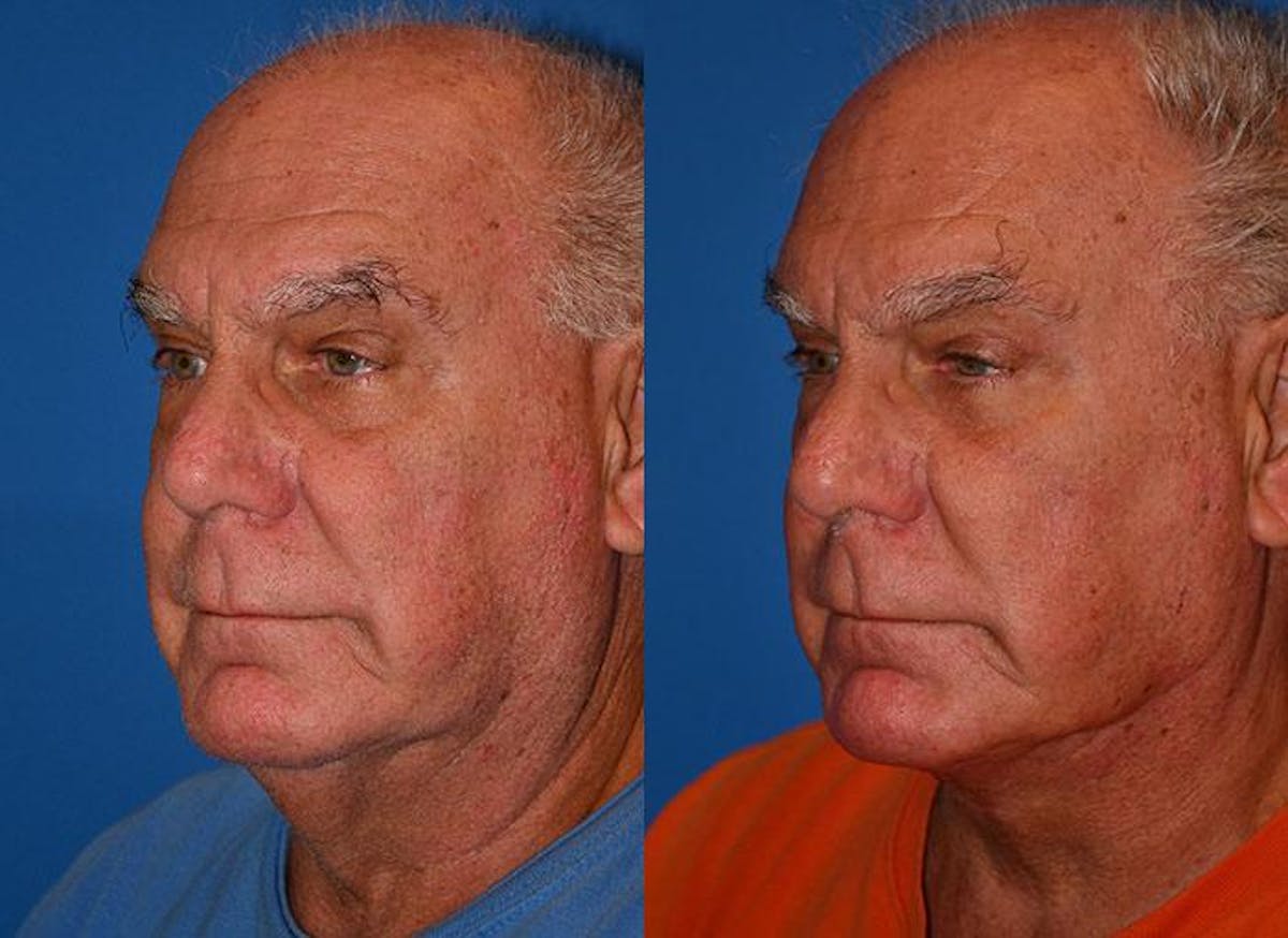 Male Neck Lift Before & After Gallery - Patient 122406313 - Image 2