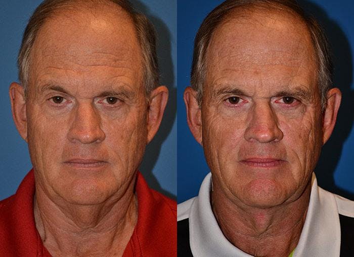 Male Neck Lift Before & After Gallery - Patient 122406314 - Image 1