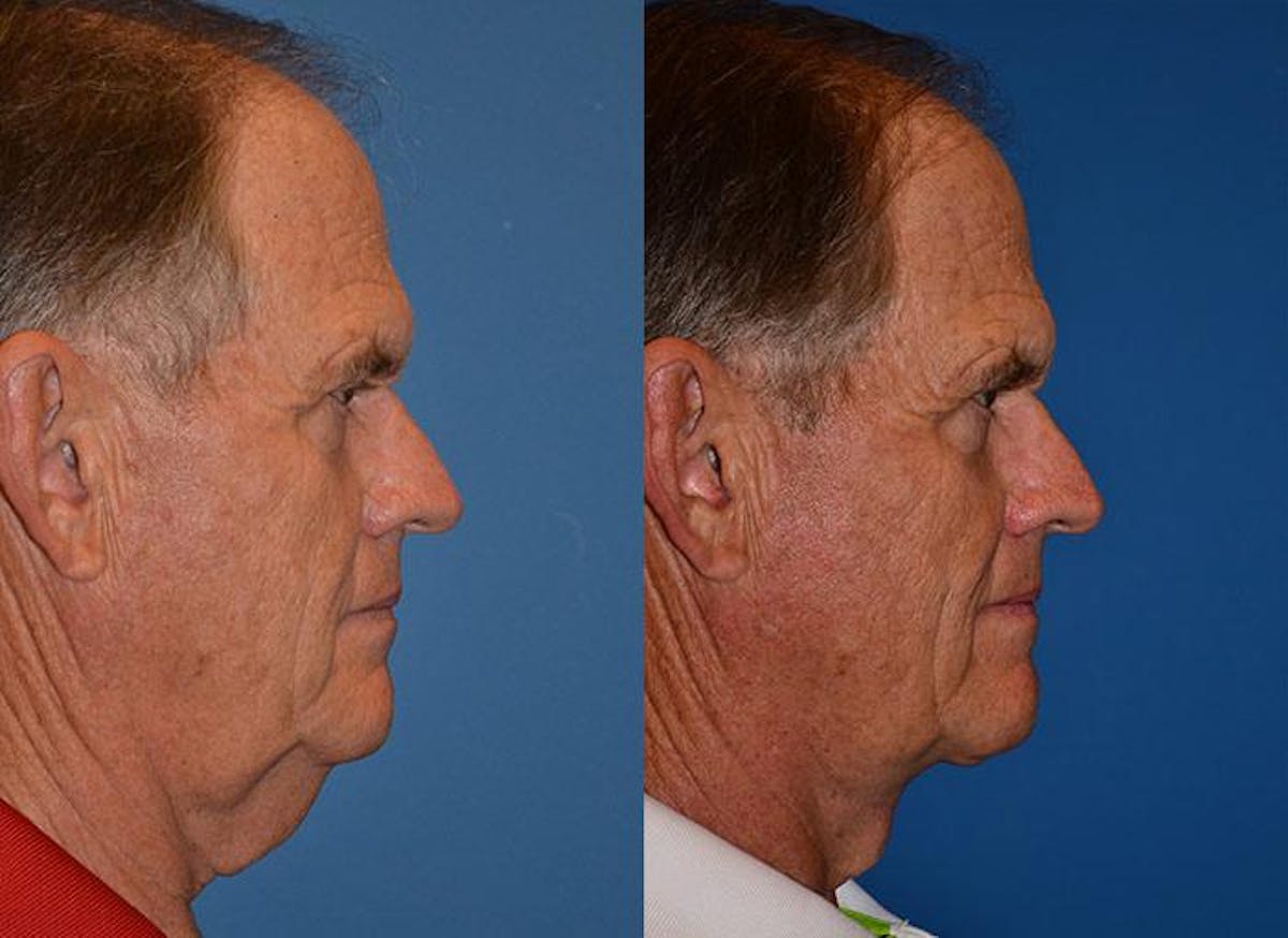 Male Neck Lift Before & After Gallery - Patient 122406314 - Image 2