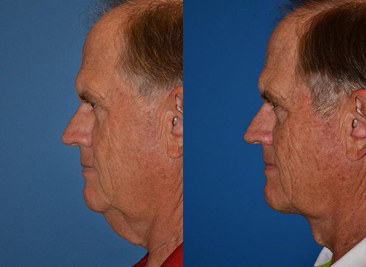 Male Neck Lift Before & After Gallery - Patient 122406314 - Image 3