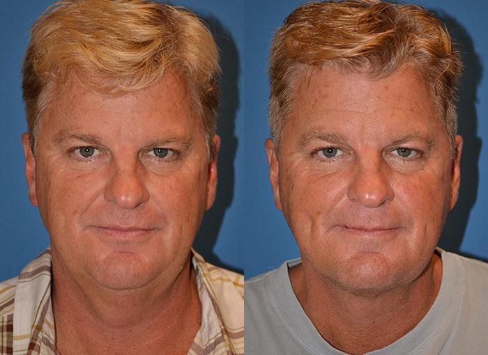 Patient 122406315 Male Neck Lift Before & After Photos Clevens Face
