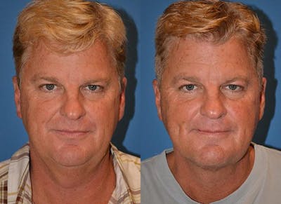 Male Neck Lift Before & After Gallery - Patient 122406315 - Image 1