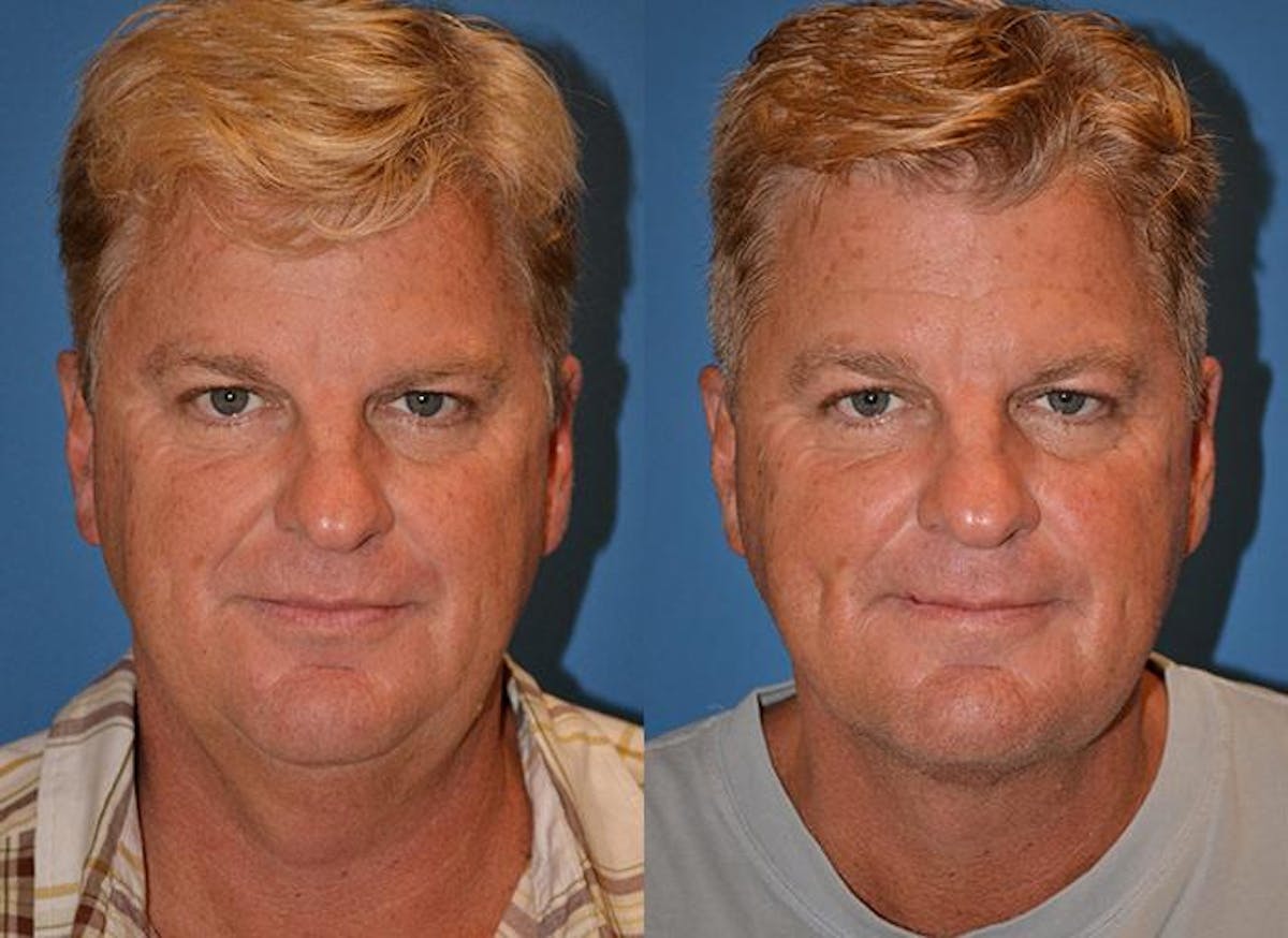 Male Neck Lift Before & After Gallery - Patient 122406315 - Image 1