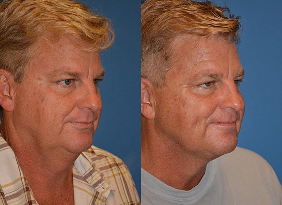 Male Neck Lift Before & After Gallery - Patient 122406315 - Image 2