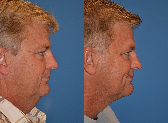 Male Neck Lift Before & After Gallery - Patient 122406315 - Image 3