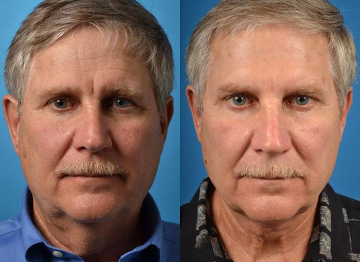 Male Neck Lift Before & After Gallery - Patient 122406316 - Image 1