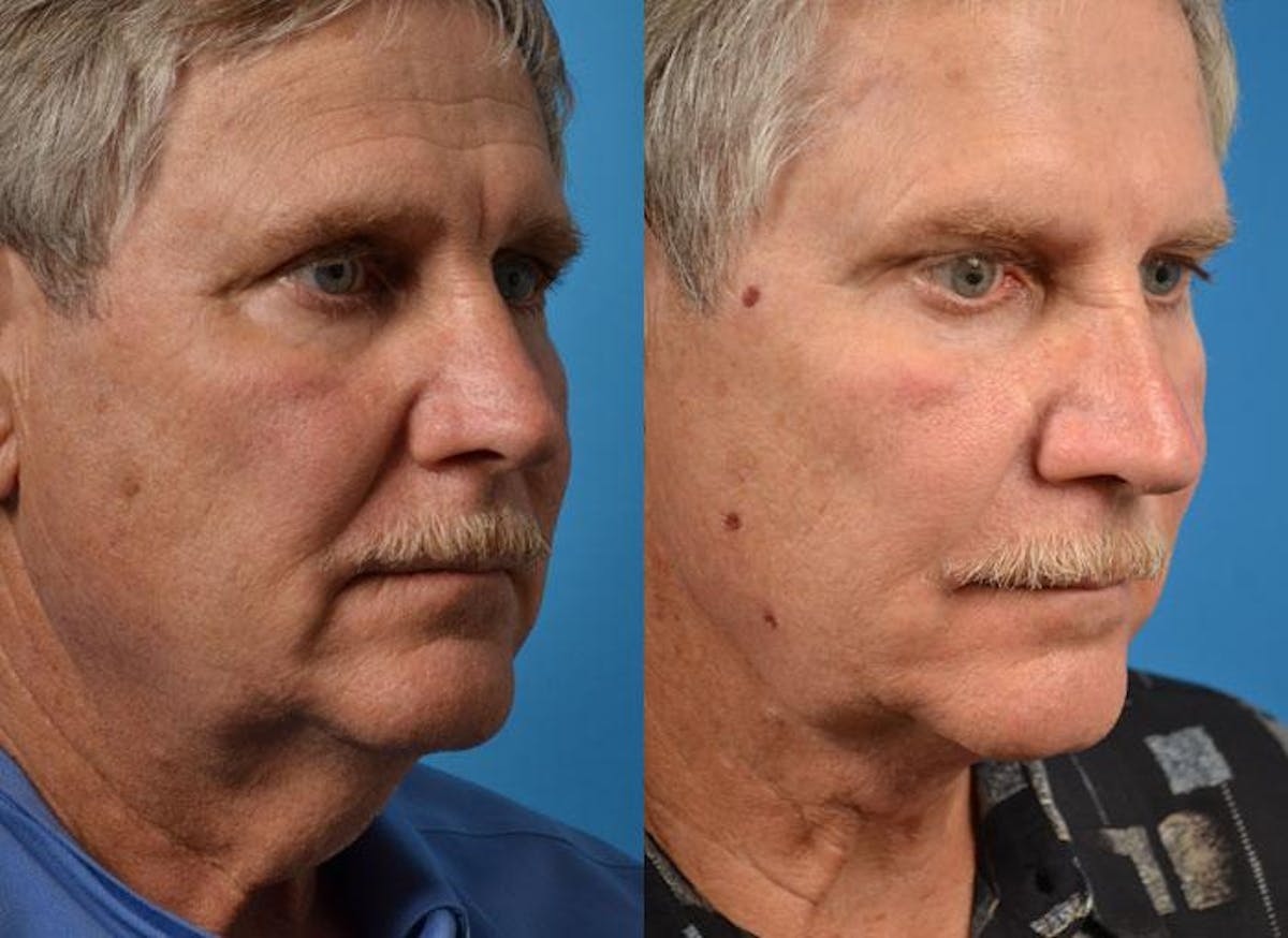 Male Neck Lift Before & After Gallery - Patient 122406316 - Image 2