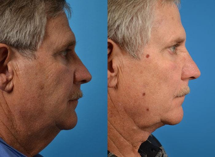Male Neck Lift Before & After Gallery - Patient 122406316 - Image 3