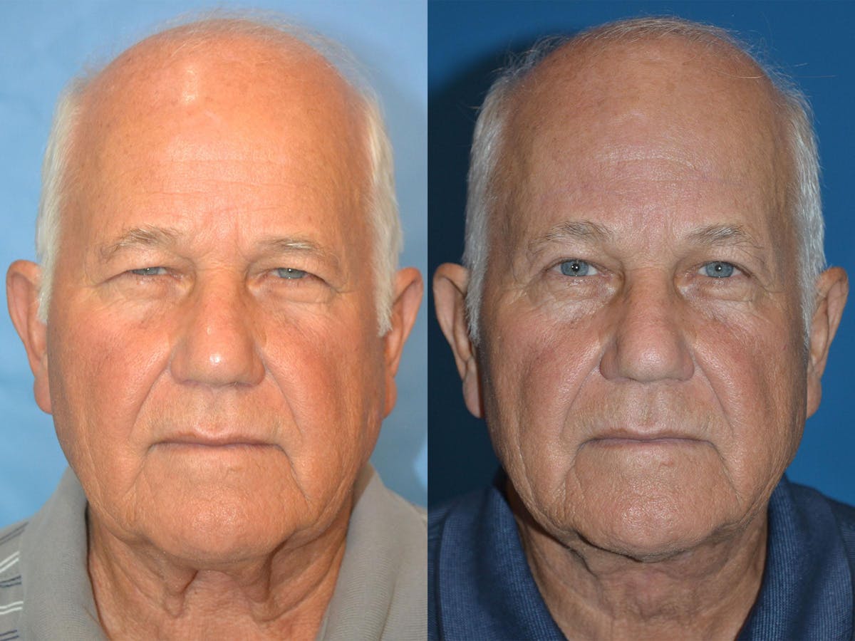 Male Neck Lift Before & After Gallery - Patient 122406317 - Image 1