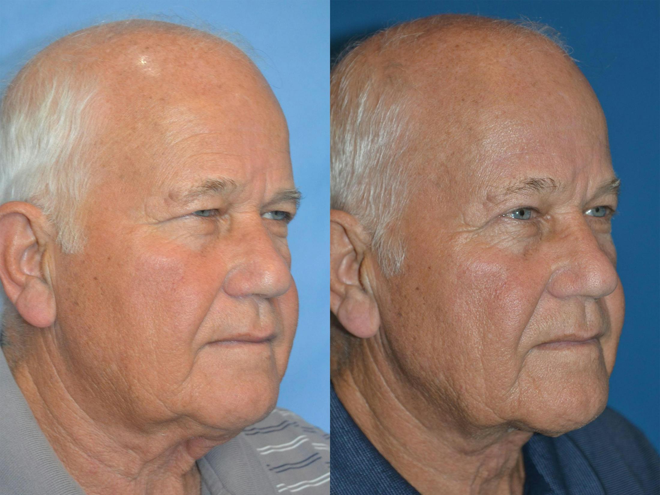 Male Neck Lift Before & After Gallery - Patient 122406317 - Image 2