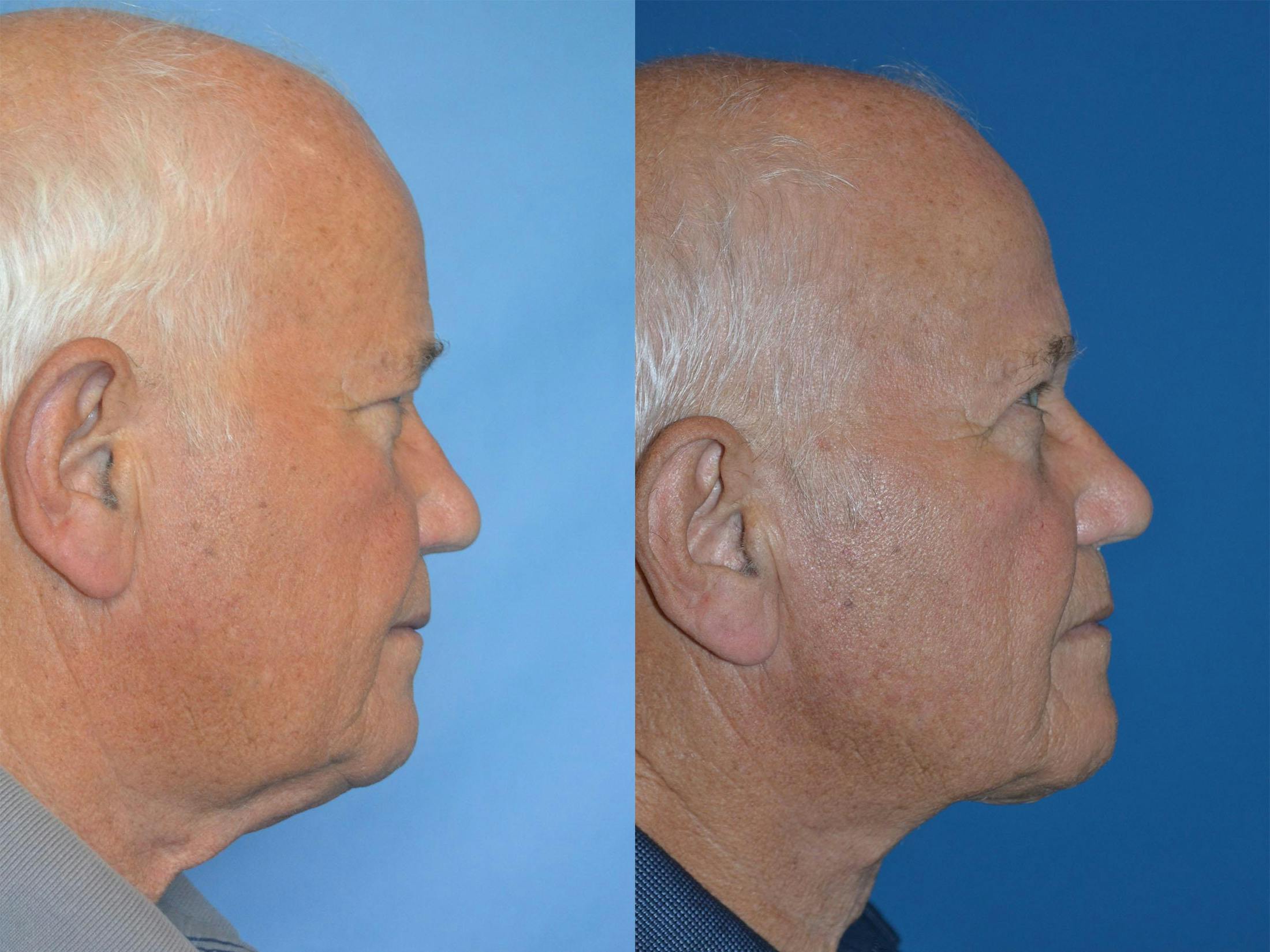 Male Neck Lift Before & After Gallery - Patient 122406317 - Image 3