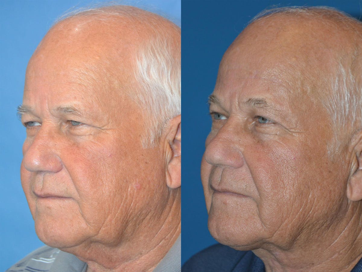 Male Neck Lift Before & After Gallery - Patient 122406317 - Image 4