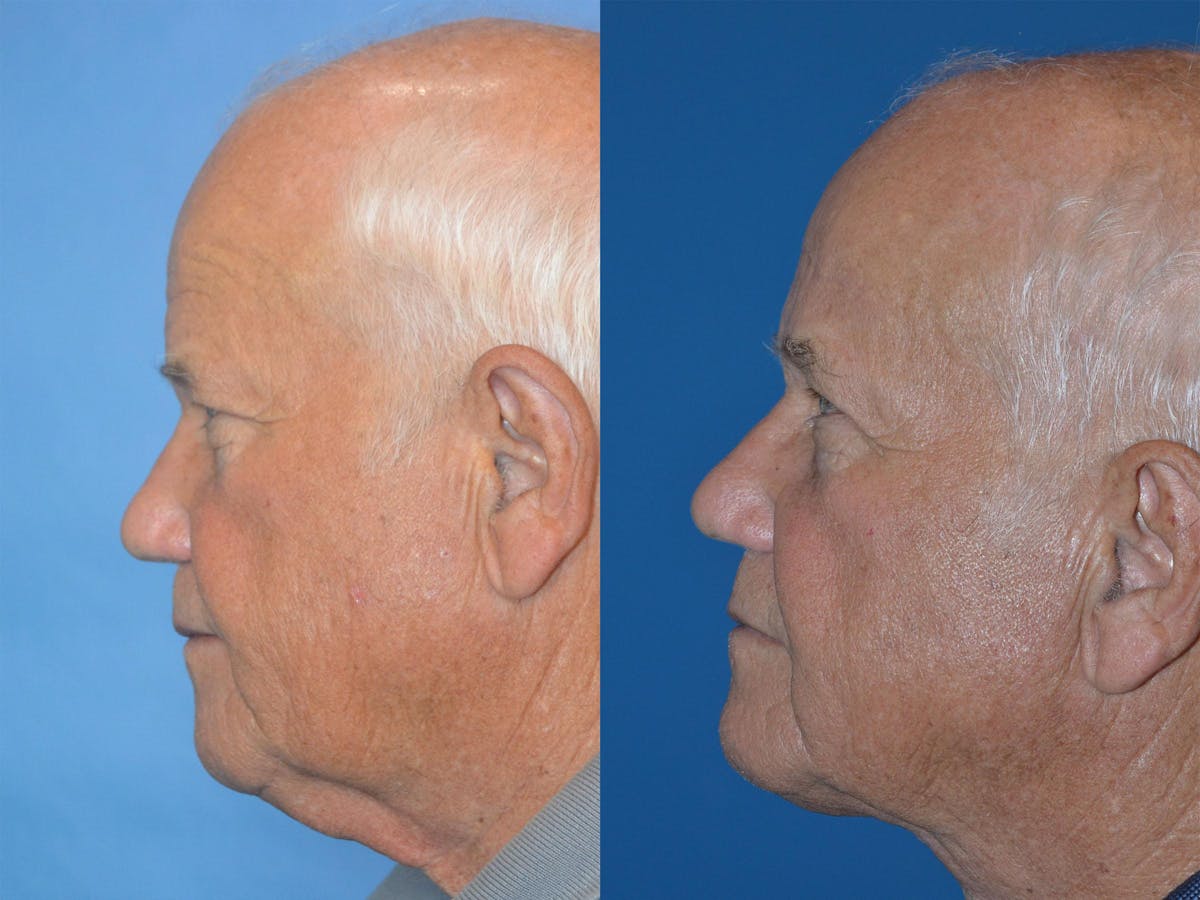 Male Neck Lift Before & After Gallery - Patient 122406317 - Image 5