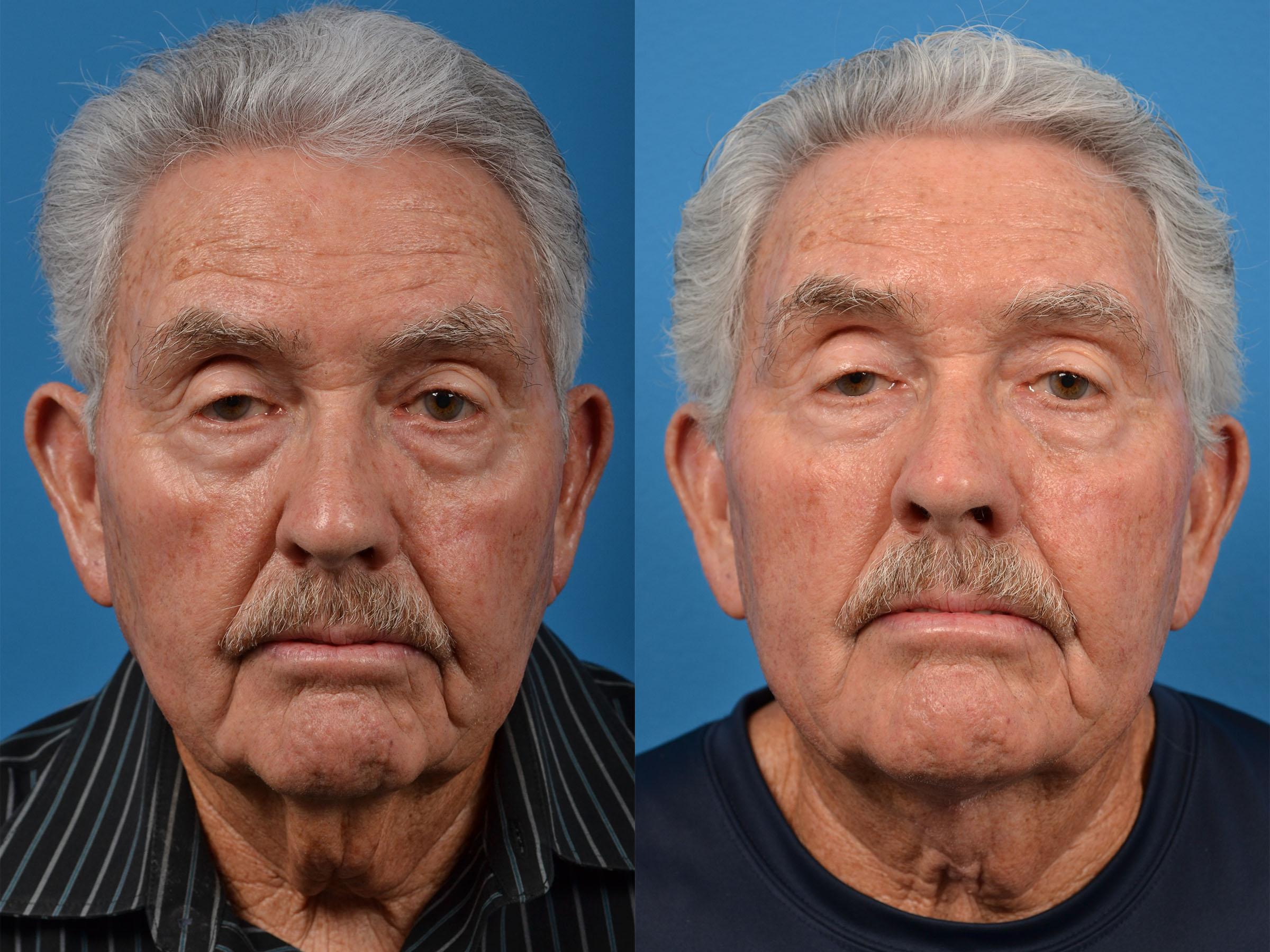 Male Neck Lift Before & After Gallery - Patient 122406324 - Image 1