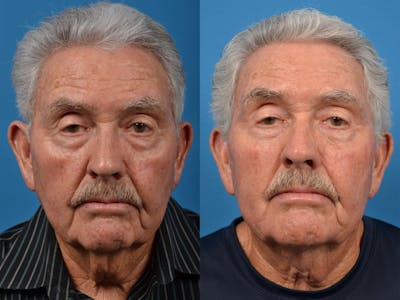 Male Neck Lift Before & After Gallery - Patient 122406324 - Image 1