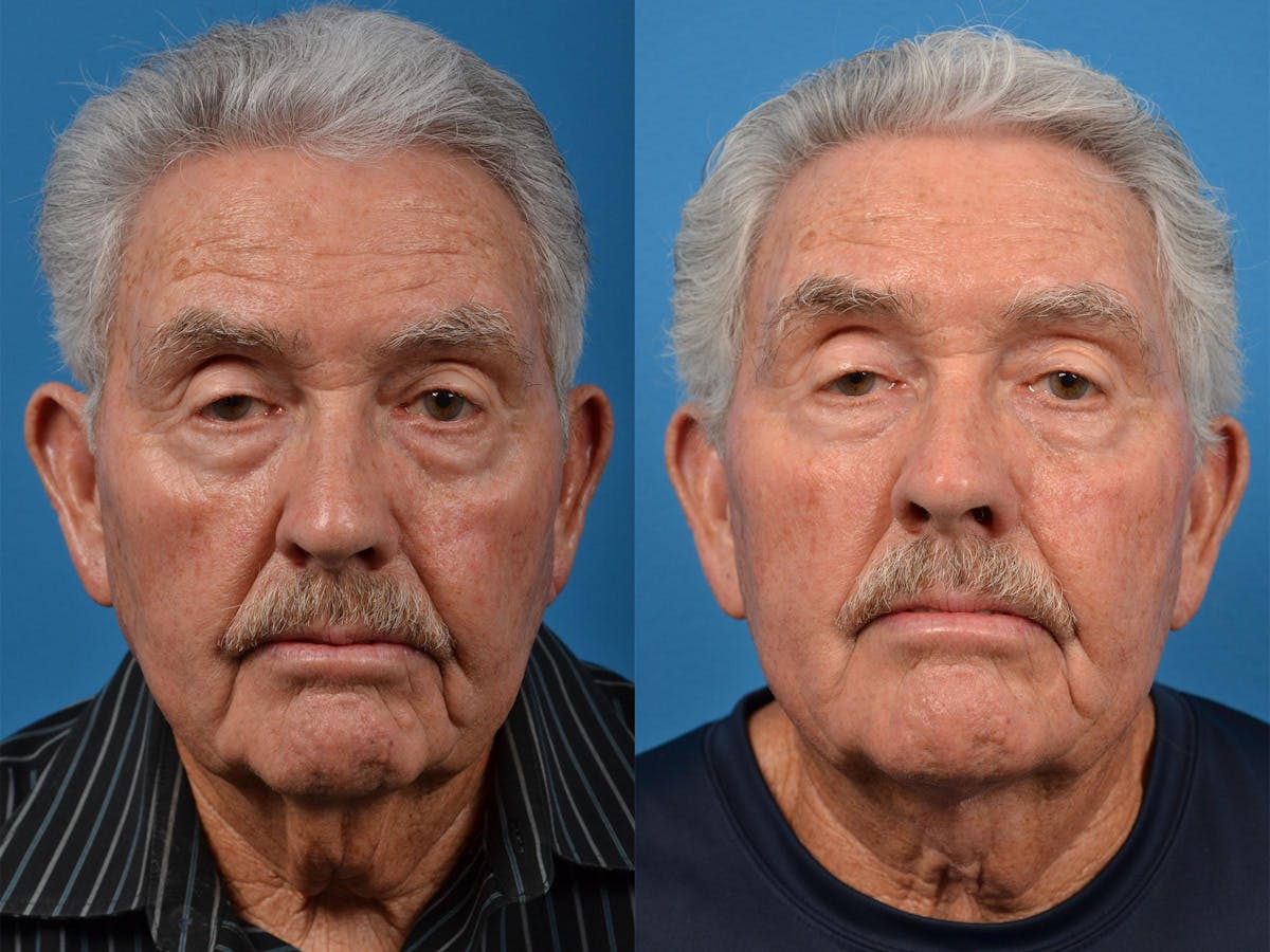Male Neck Lift Before & After Gallery - Patient 122406324 - Image 1