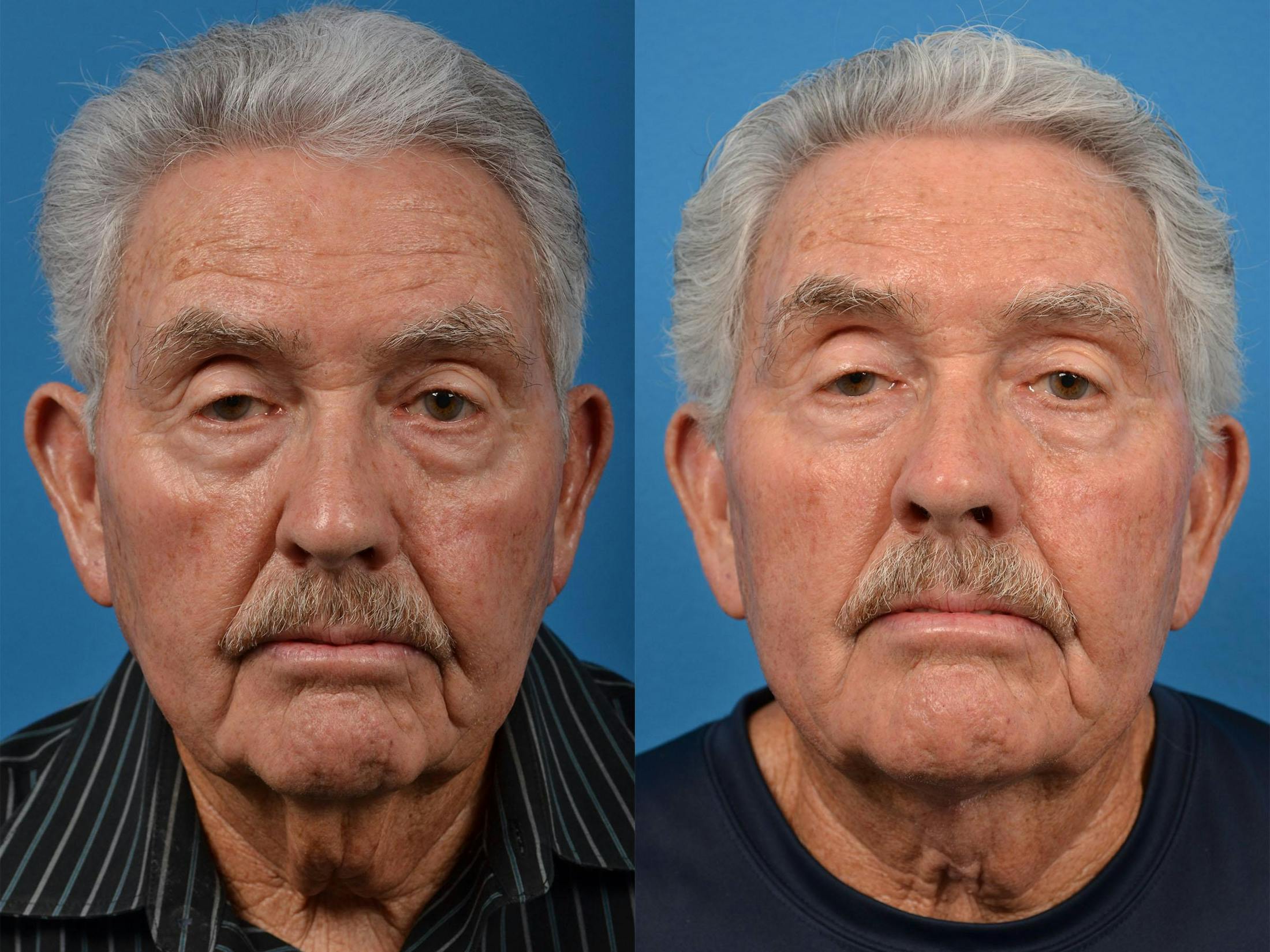 Male Neck Lift Gallery - Patient 122406324 - Image 1