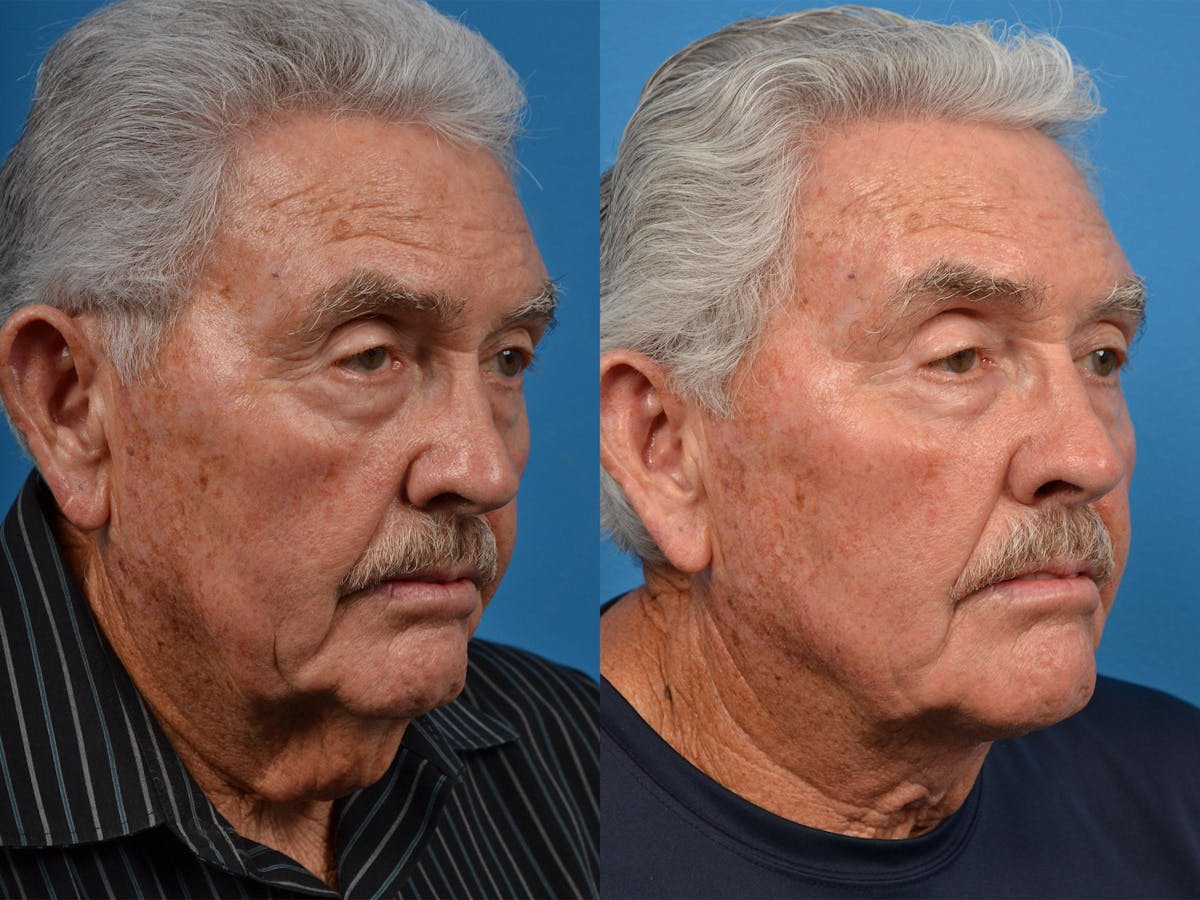 Male Neck Lift Before & After Gallery - Patient 122406324 - Image 2