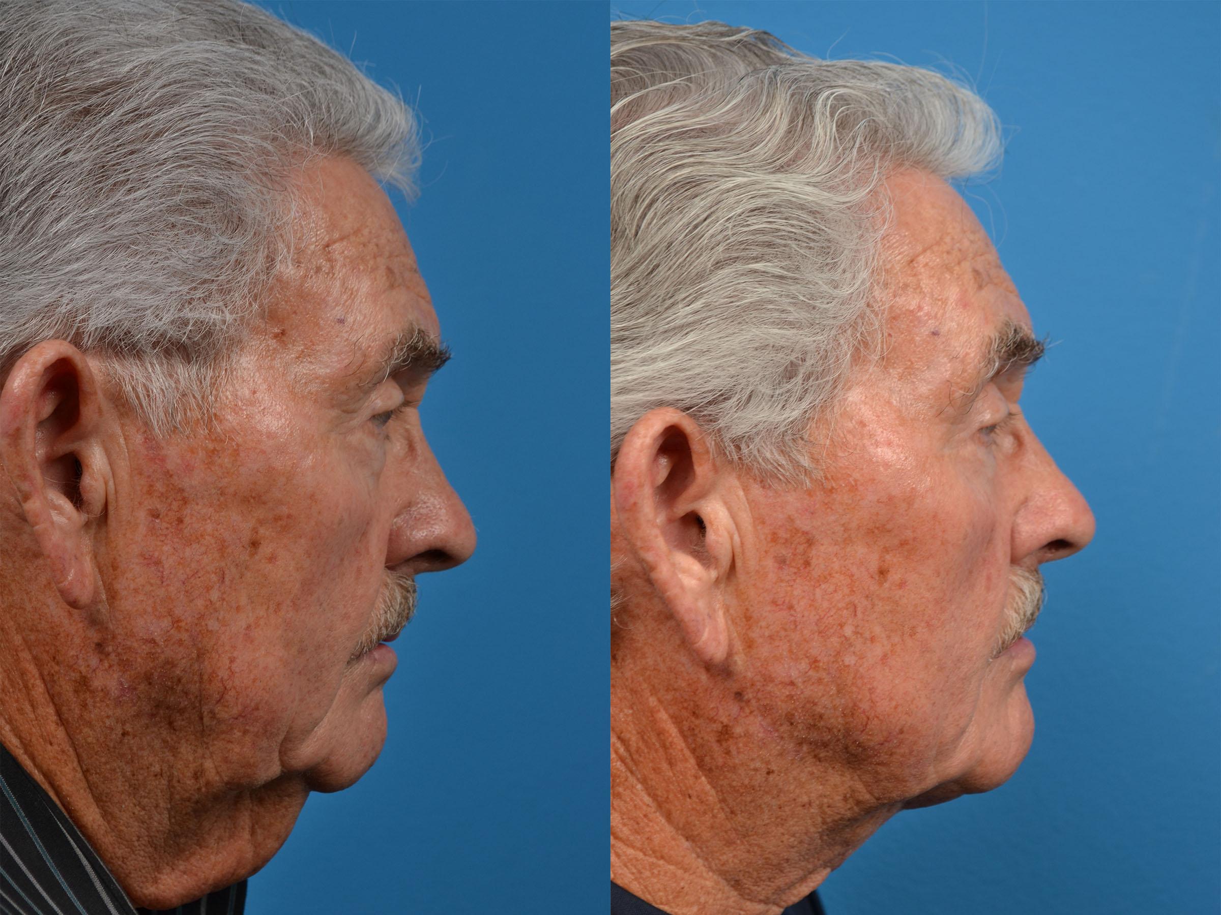 Male Neck Lift Before & After Gallery - Patient 122406324 - Image 3