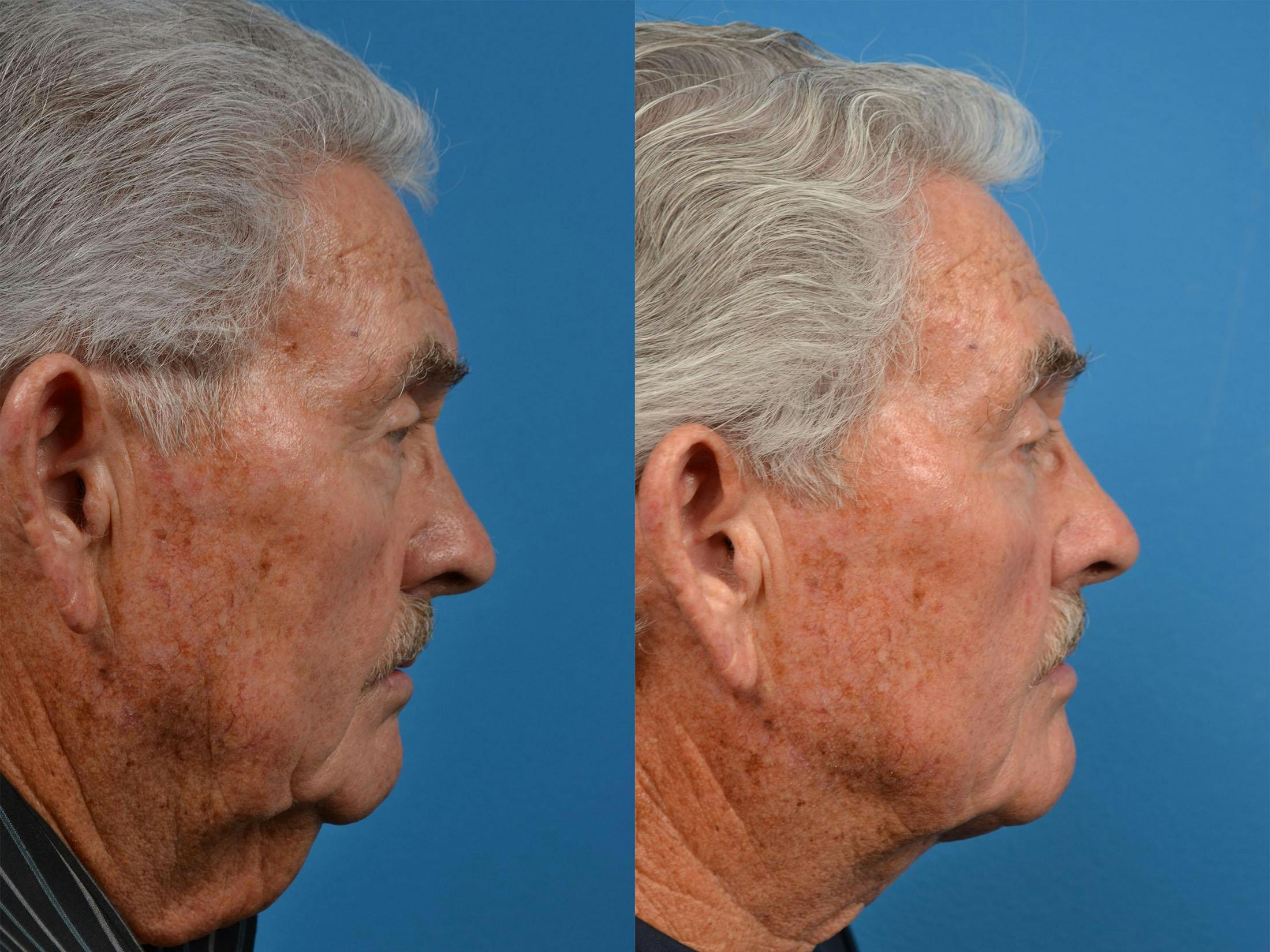 Male Neck Lift Gallery - Patient 122406324 - Image 3
