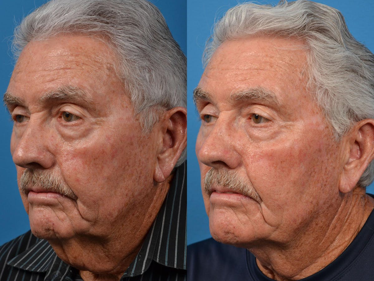 Male Neck Lift Before & After Gallery - Patient 122406324 - Image 4