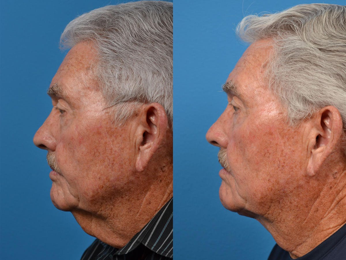 Male Neck Lift Before & After Gallery - Patient 122406324 - Image 5