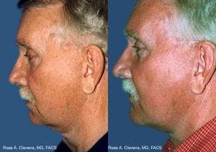 Male Neck Lift Before & After Gallery - Patient 122406325 - Image 1