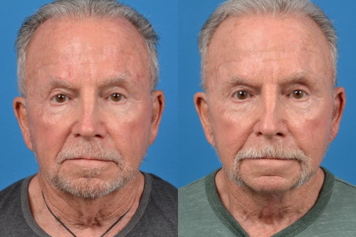 Male Neck Lift Before & After Gallery - Patient 122406326 - Image 1