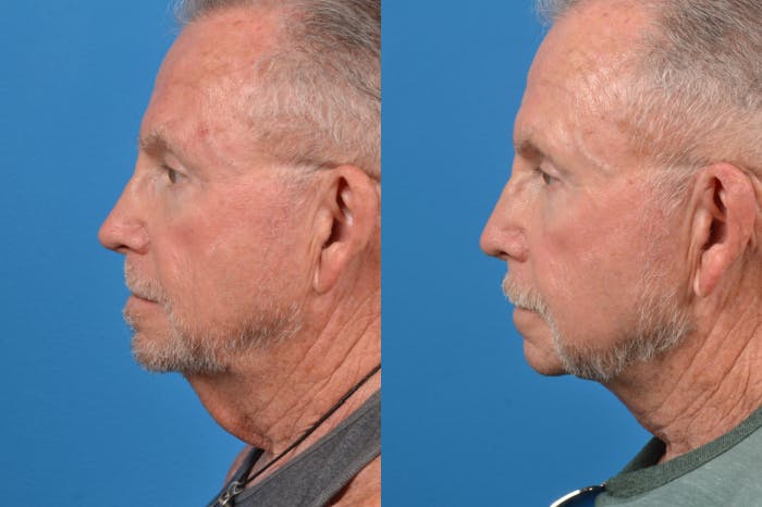 Male Neck Lift Before & After Gallery - Patient 122406326 - Image 2