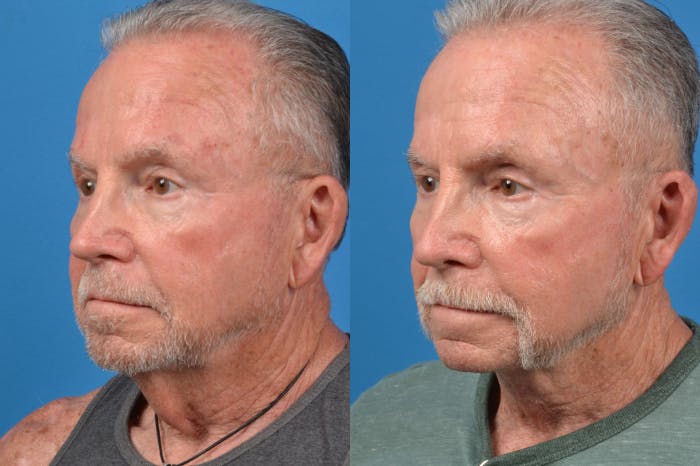 Male Neck Lift Before & After Gallery - Patient 122406326 - Image 3