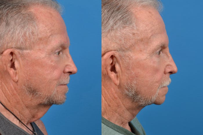 Patient 122406326 Male Neck Lift Before And After Photos Clevens Face