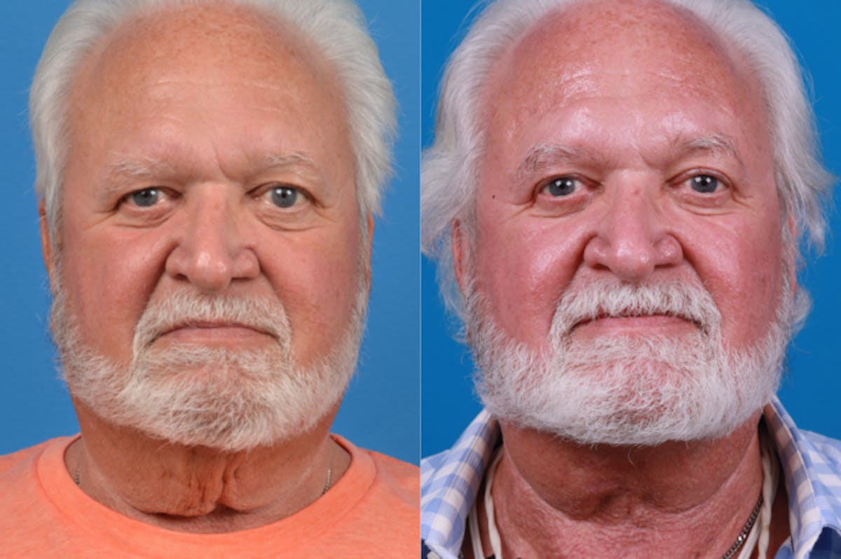 Male Neck Lift Before & After Gallery - Patient 122406327 - Image 1