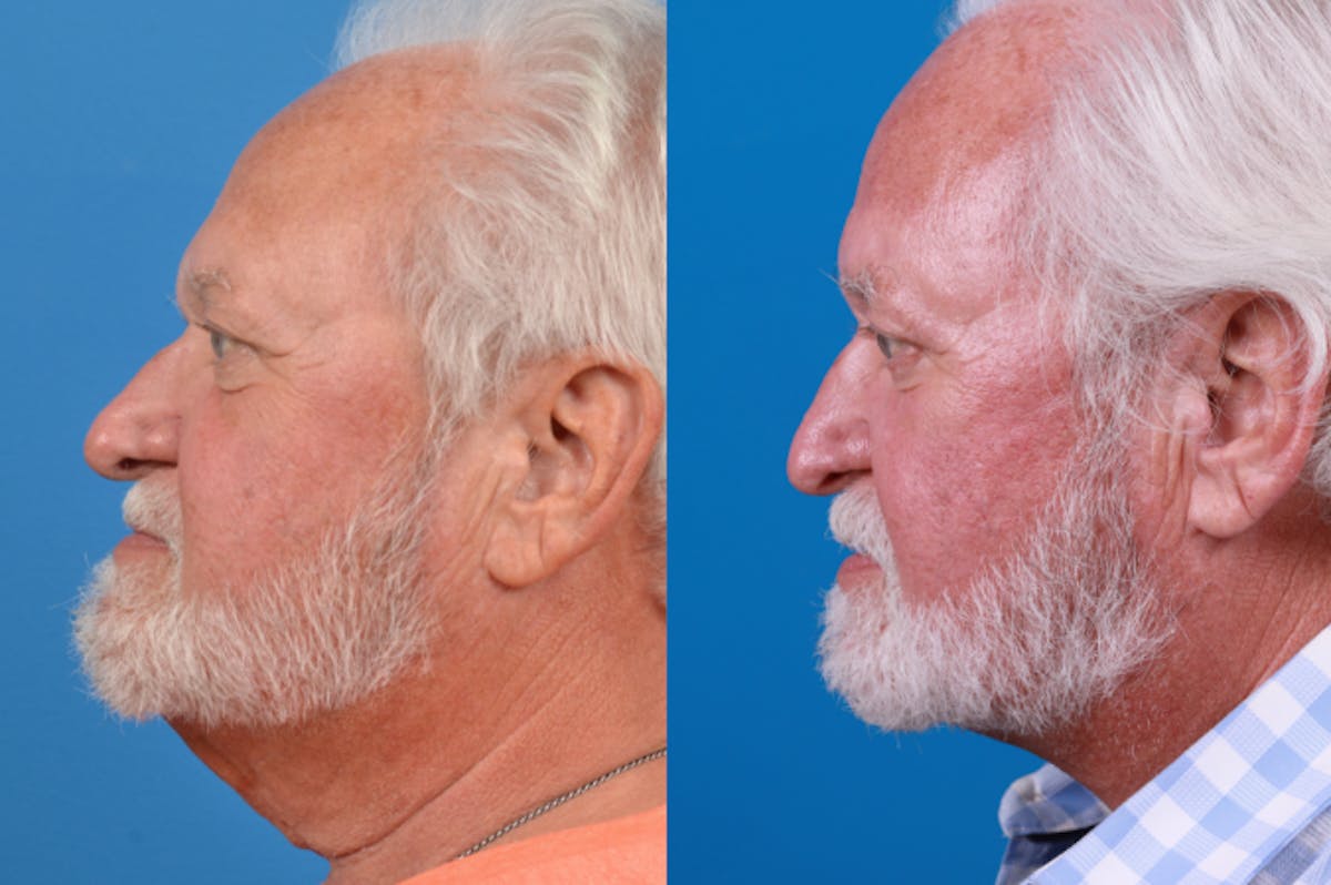 Male Neck Lift Before & After Gallery - Patient 122406327 - Image 2