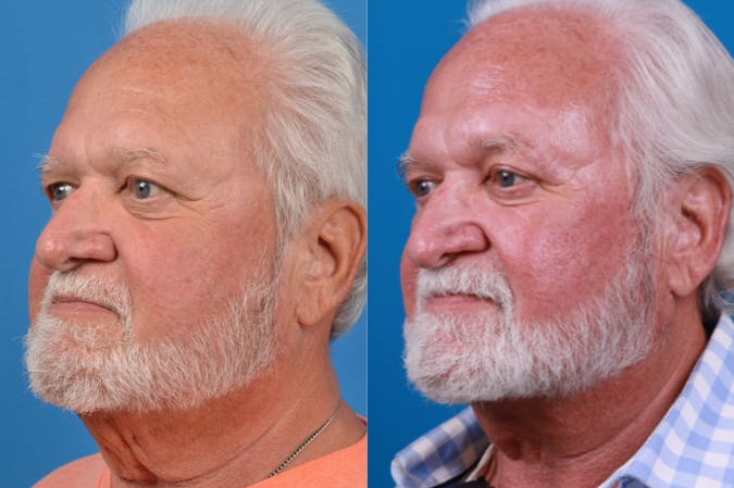 Male Neck Lift Before & After Gallery - Patient 122406327 - Image 3